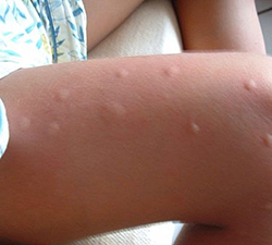 укусы комаров у детей